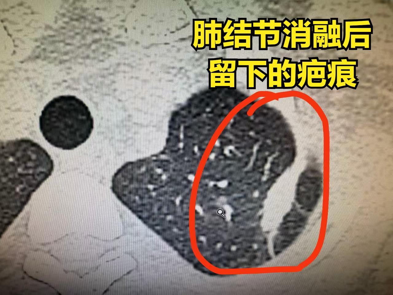 肺结节要不要做消融？今天我就把这个问题讲透彻！“消”是消灭的消，“融”是融化的融
