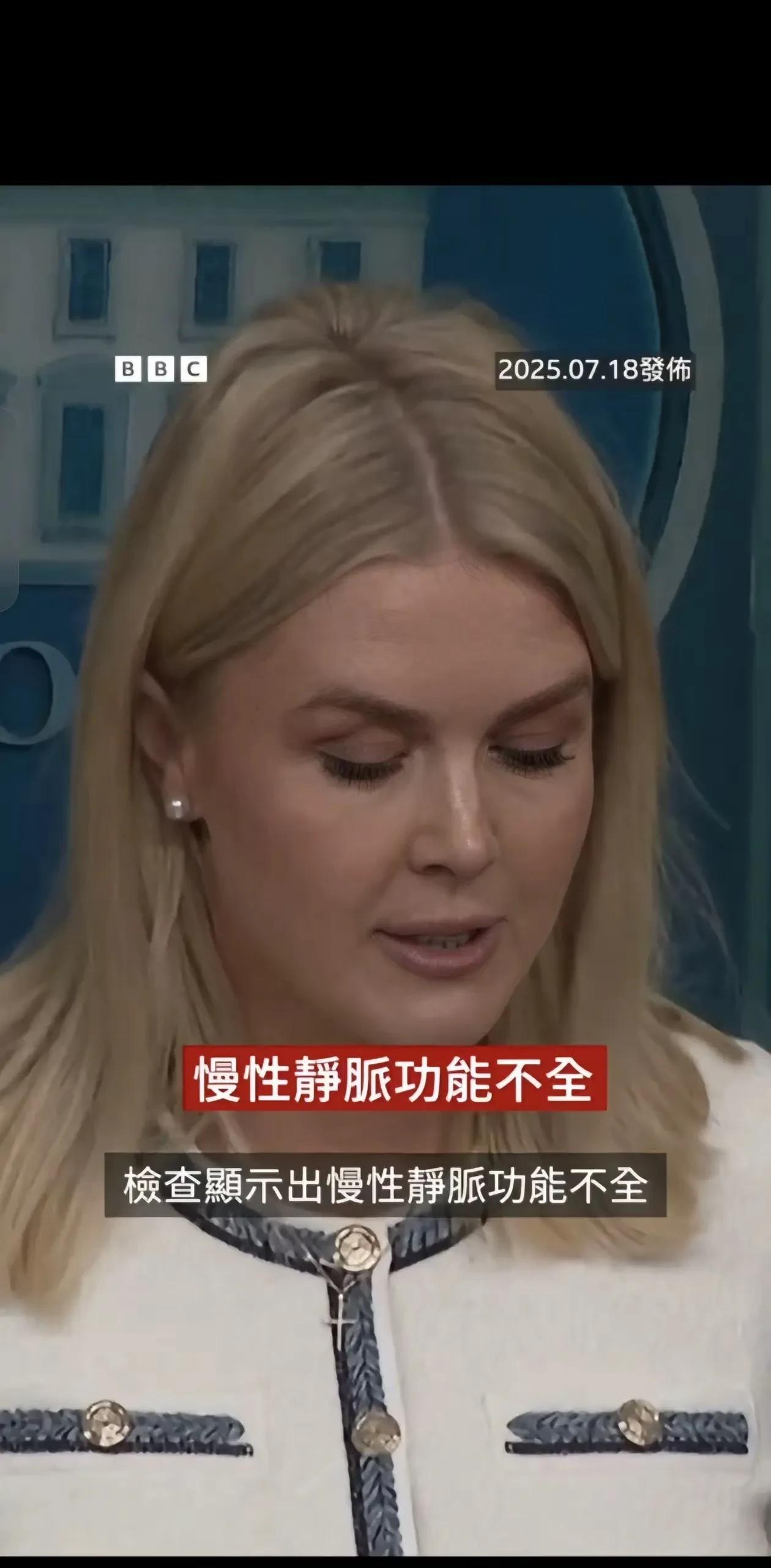川普确实老了，图2-3是他的手。医生诊断结果就是说是他握手握多了，导致静脉曲张