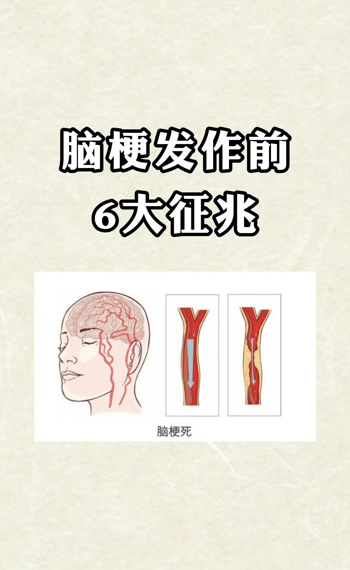 我爸突发脑梗我才关注的脑梗原来有预警，这预警知道可以提前检查一下。我爸就是右侧胳