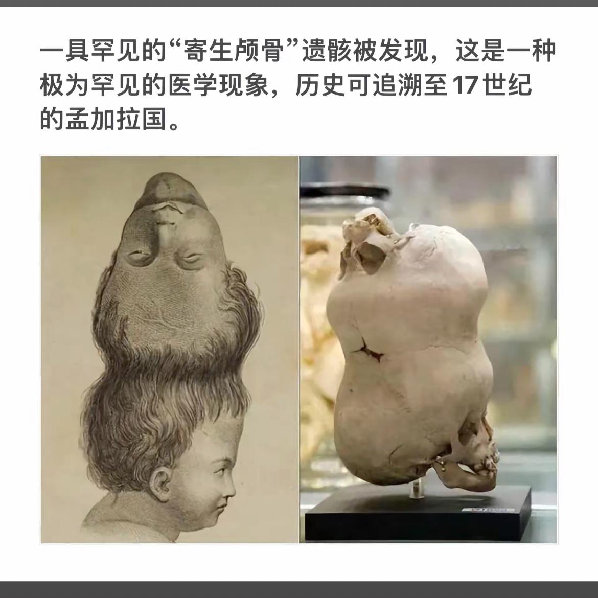 “寄生颅骨”的神秘发现，追溯至17世纪的孟加拉国！🔍💀🔬