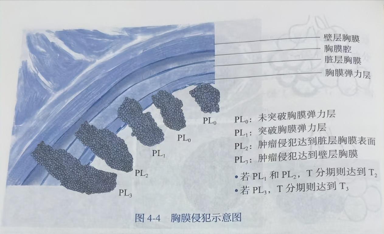 很多朋友问我关于“肺结节胸膜侵犯”的问题，我给大家打个很形象的比方，听完您就懂了