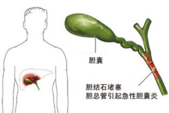 胆结石是吃出来的吗? 得了结石到底该怎么办?