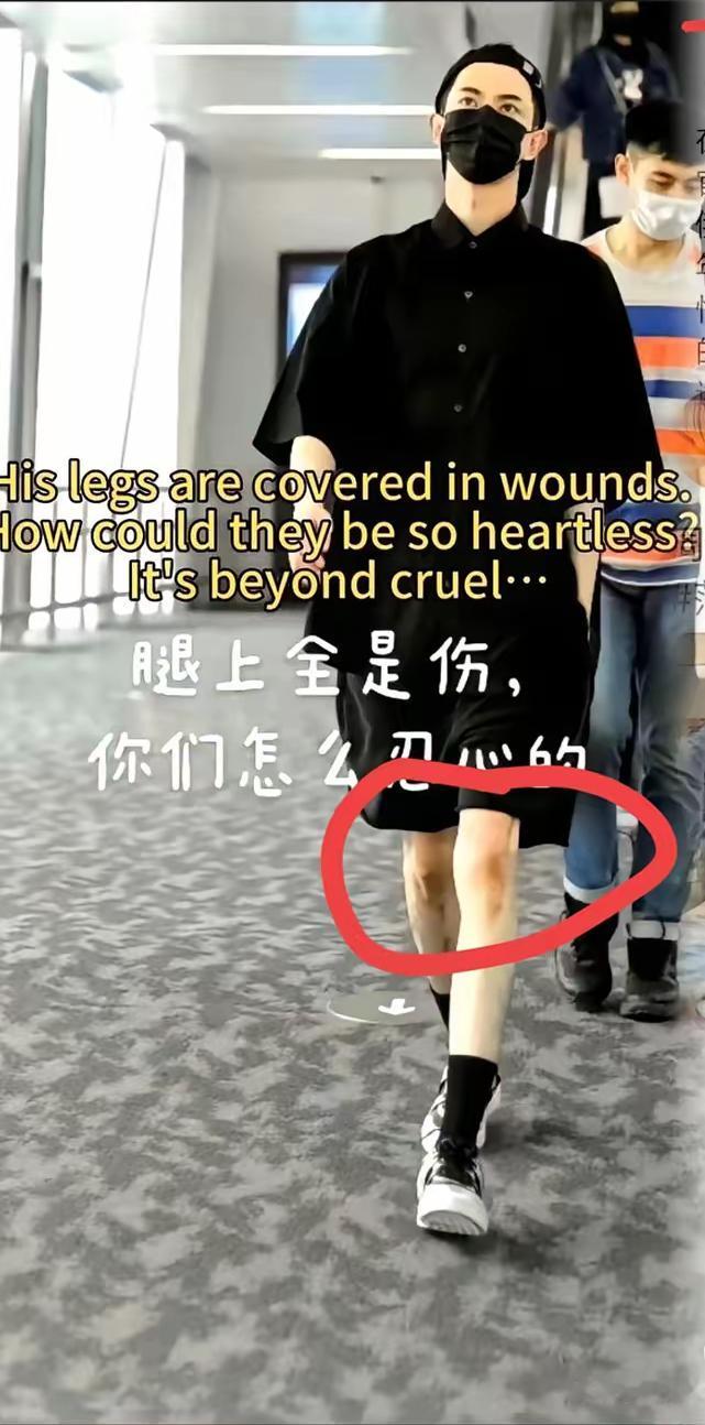 “看得到的伤痕，却是看不见的心疼。”照片里的淤青让人心疼。之前听说他口罩里