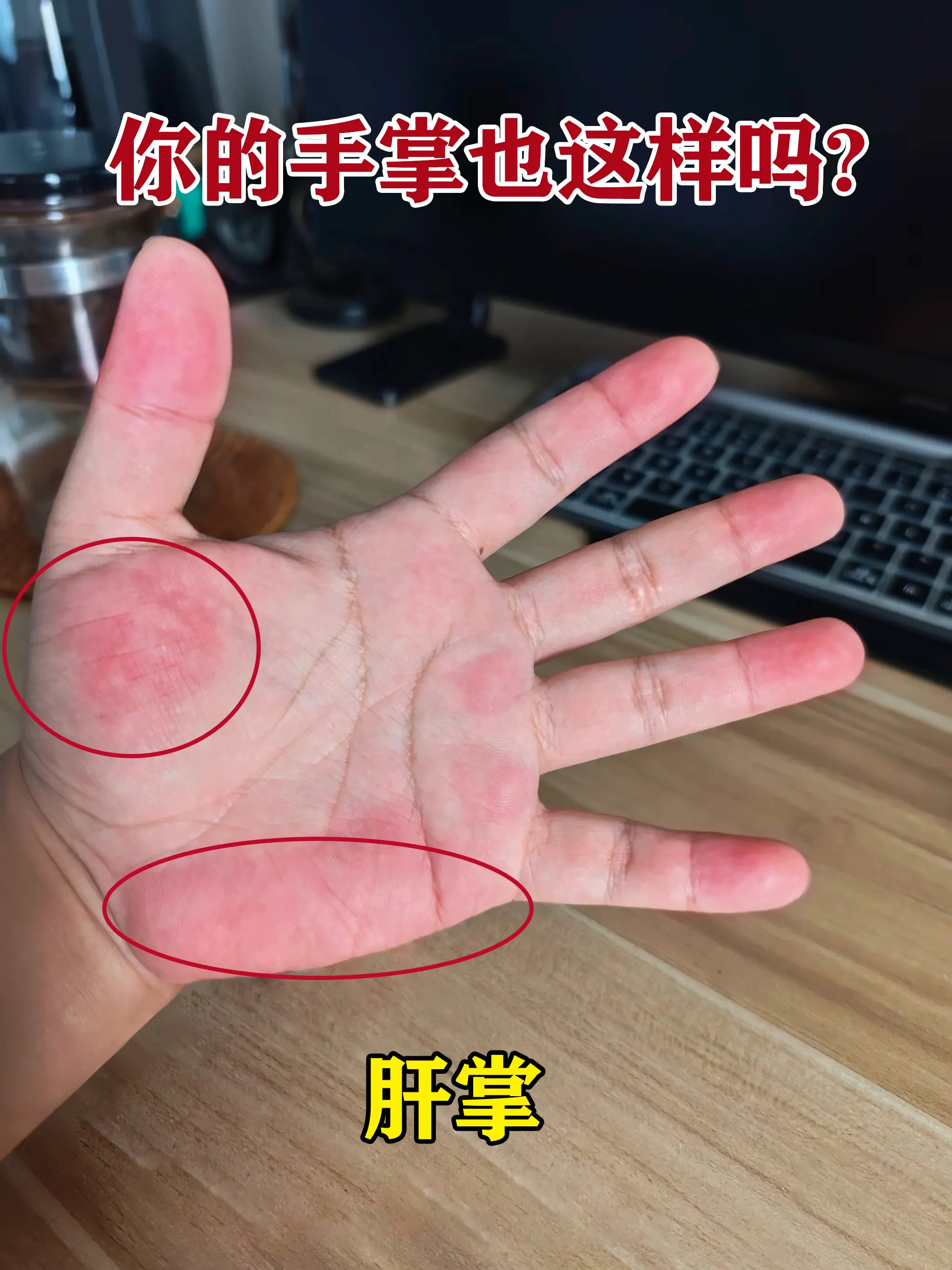 最近不少人看到手掌发红就担心是肝掌，其实大部分都不是。 真正的肝掌集中...