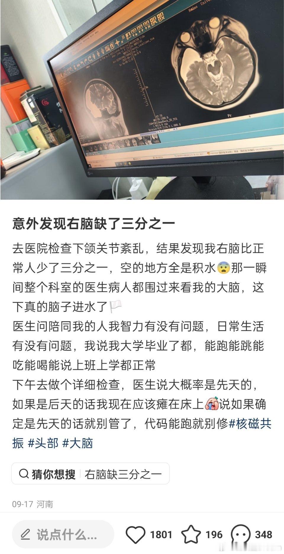 网友意外发现右脑缺了三分之一，医生说如果确定是先天的话就别管了，代码能跑就别修