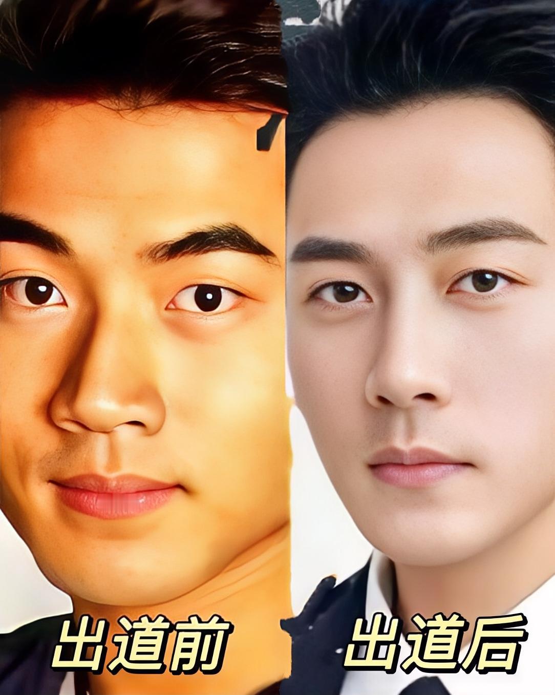 其实就是弄了个双眼皮吧