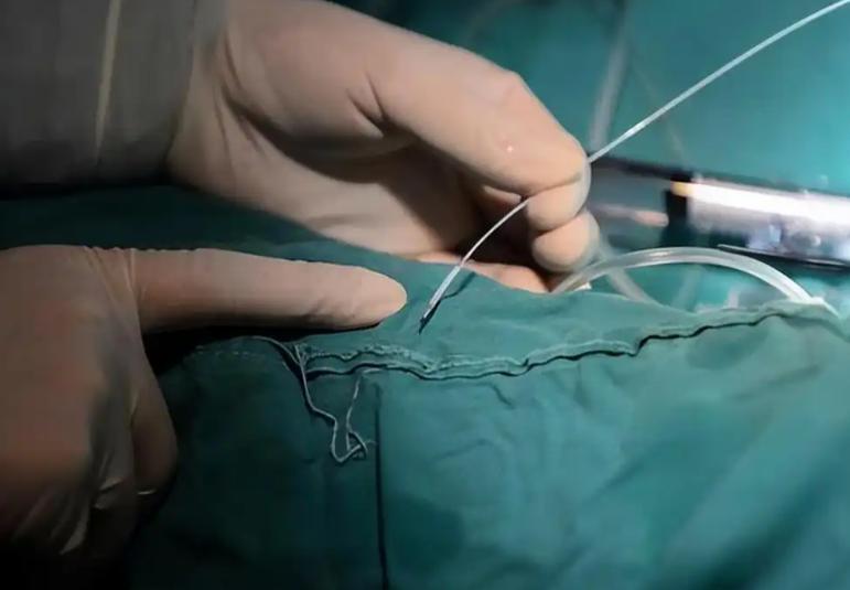 冠状动脉堵了70%，必须放心脏支架？医生说实话：先看这3点一听到冠状动脉堵了