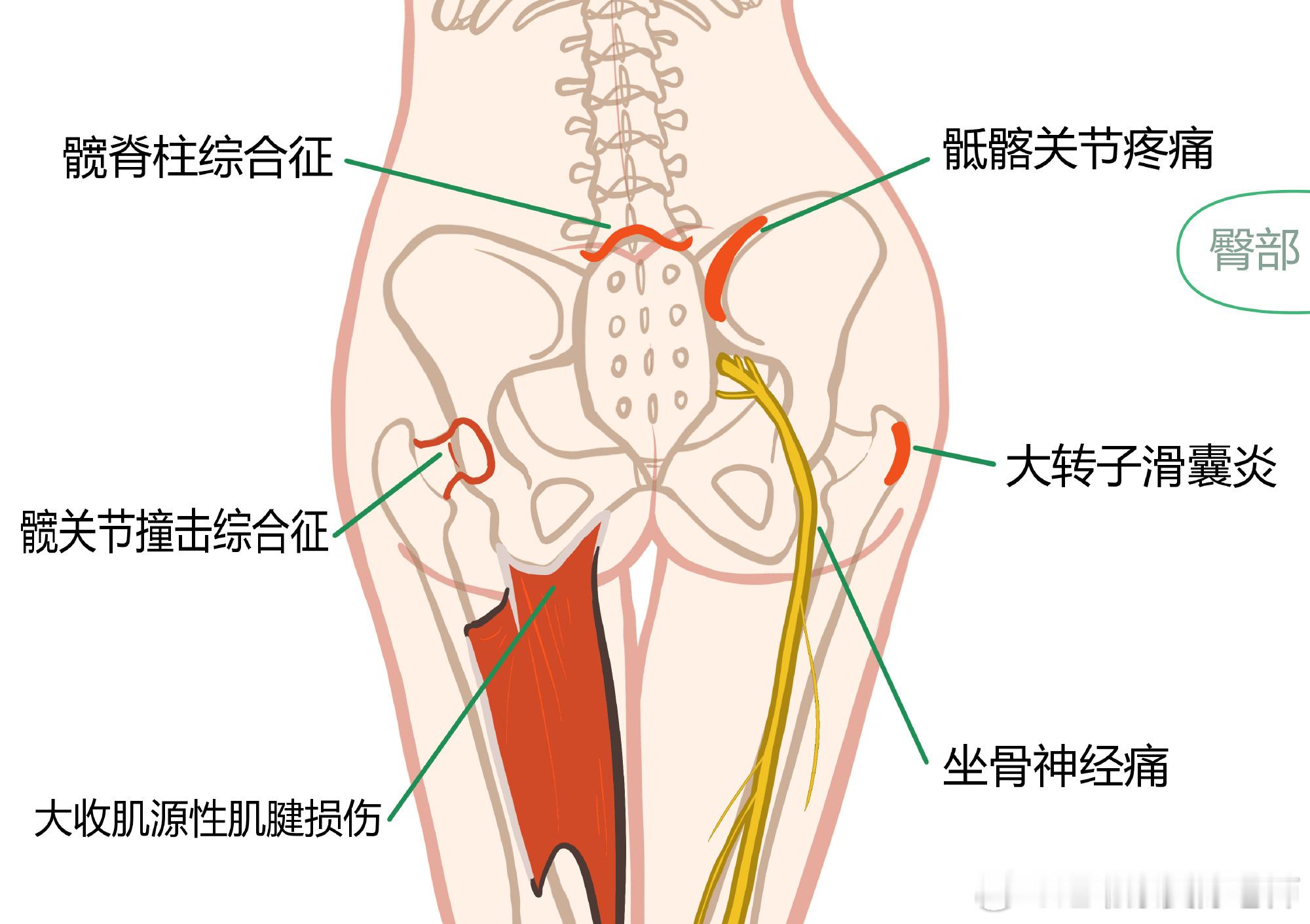 臀部损伤腰疼屁股疼，甚至影响到了整个下肢？总结了一波臀部常见损伤，对照图片，看