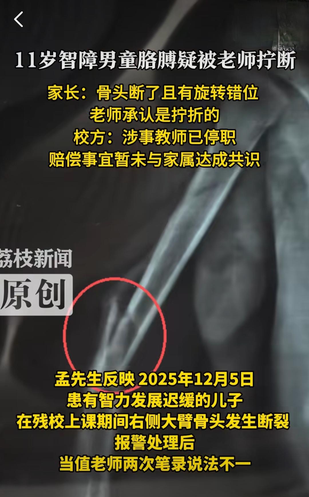 辽宁铁岭的孟先生怎么也没想到，自己放心送去特殊学校的儿子，会在课堂上遭遇这样的伤