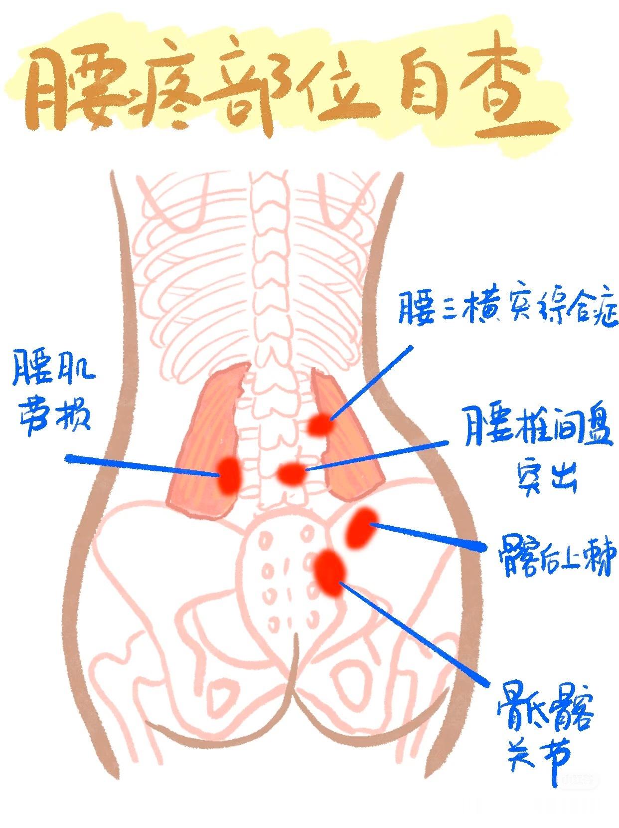 腰痛【腰部疼痛解析】今天继续来讲腰椎，常见的损伤原因与症状：①【腰三横突综合征
