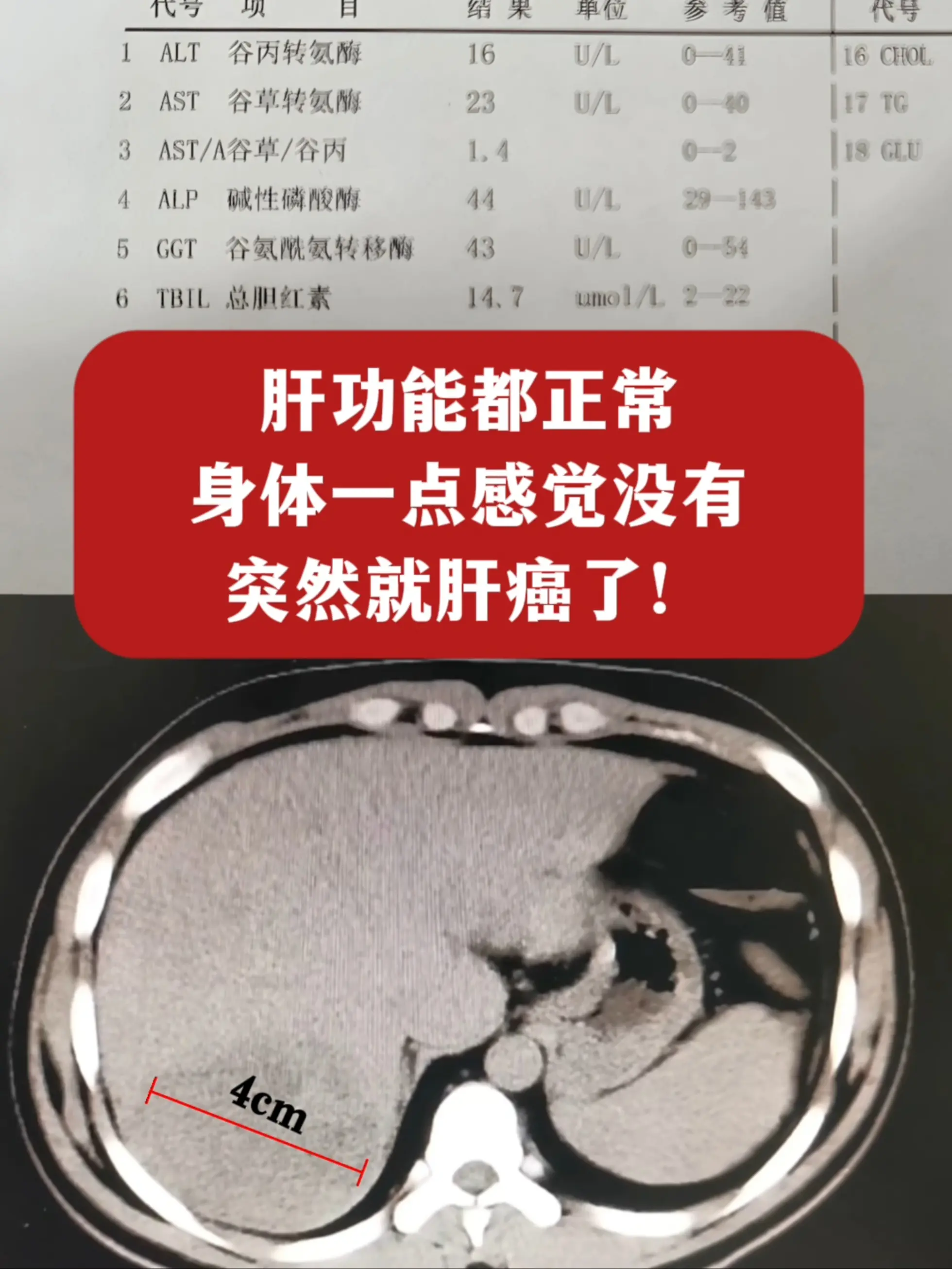 哎，这就是肝癌的可怕之处啊！山西的一位 53 岁患者，查出来乙肝肝硬化...
