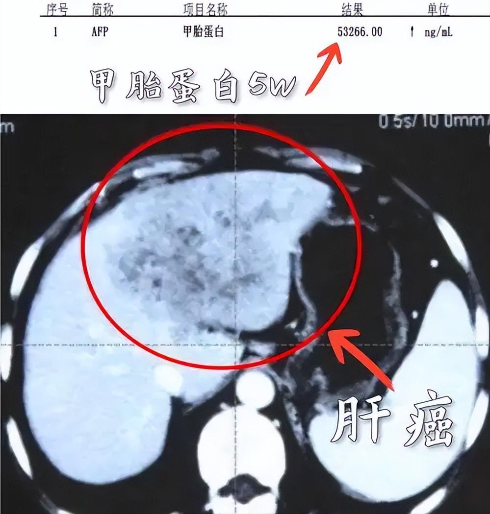 这4类人是肝癌“高危人群”，快看看你在不在其中！从事肝病诊疗20余年，我见过