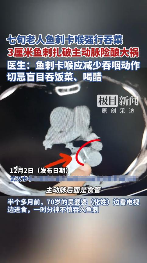 这下后悔了吧！近日，湖北武汉，一老太边吃鱼时，不小心吞下一根鱼刺！鱼刺卡在喉咙里