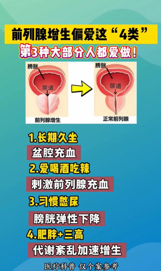 诱发前列腺增生的四类高危习惯，憋尿、久坐需尽早改正