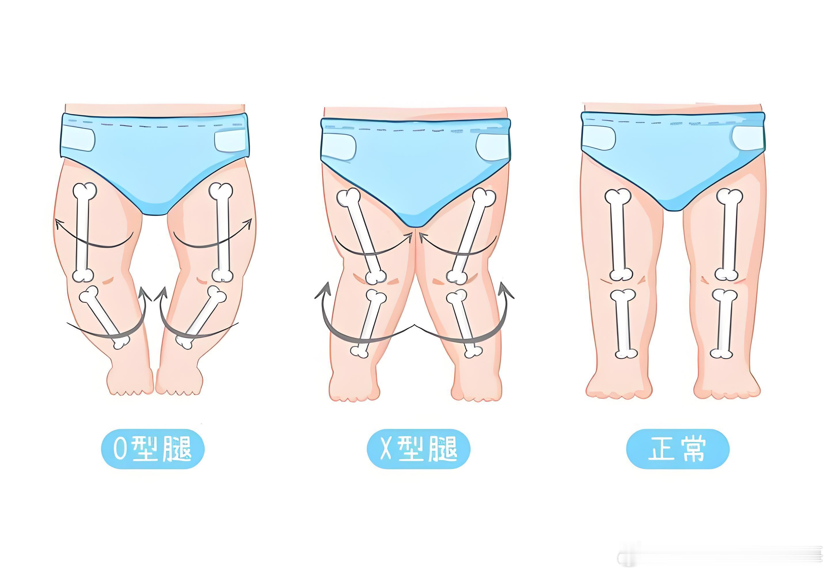 新手家长大多都有这种焦虑：宝宝腿不直、有点弯，会不会是O型腿、X型腿？给家长吃颗