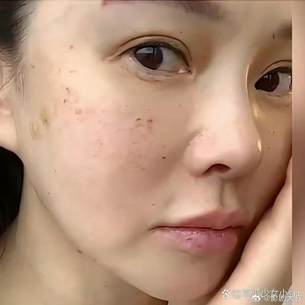 伊能静大方晒出自己的打针照片，果然，女明星为了容颜不老都很拼​​​
