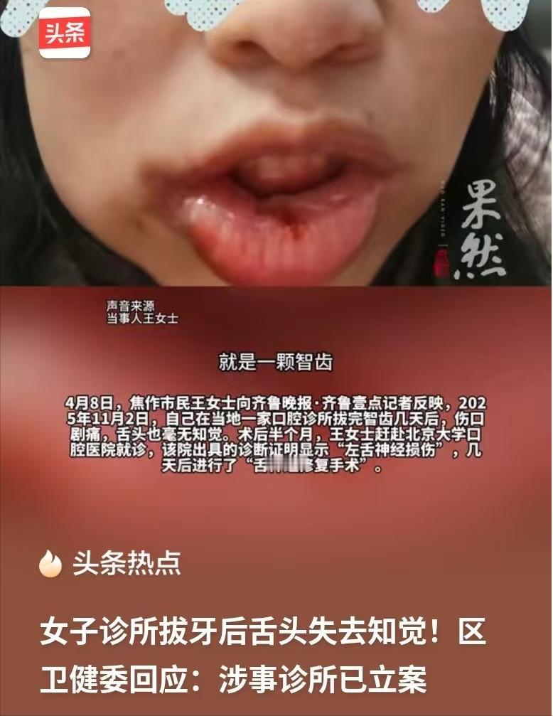 备孕拔智齿竟致舌头“瘫痪”！河南女子的噩梦：700元手术，5万元治疗费，半年仍无