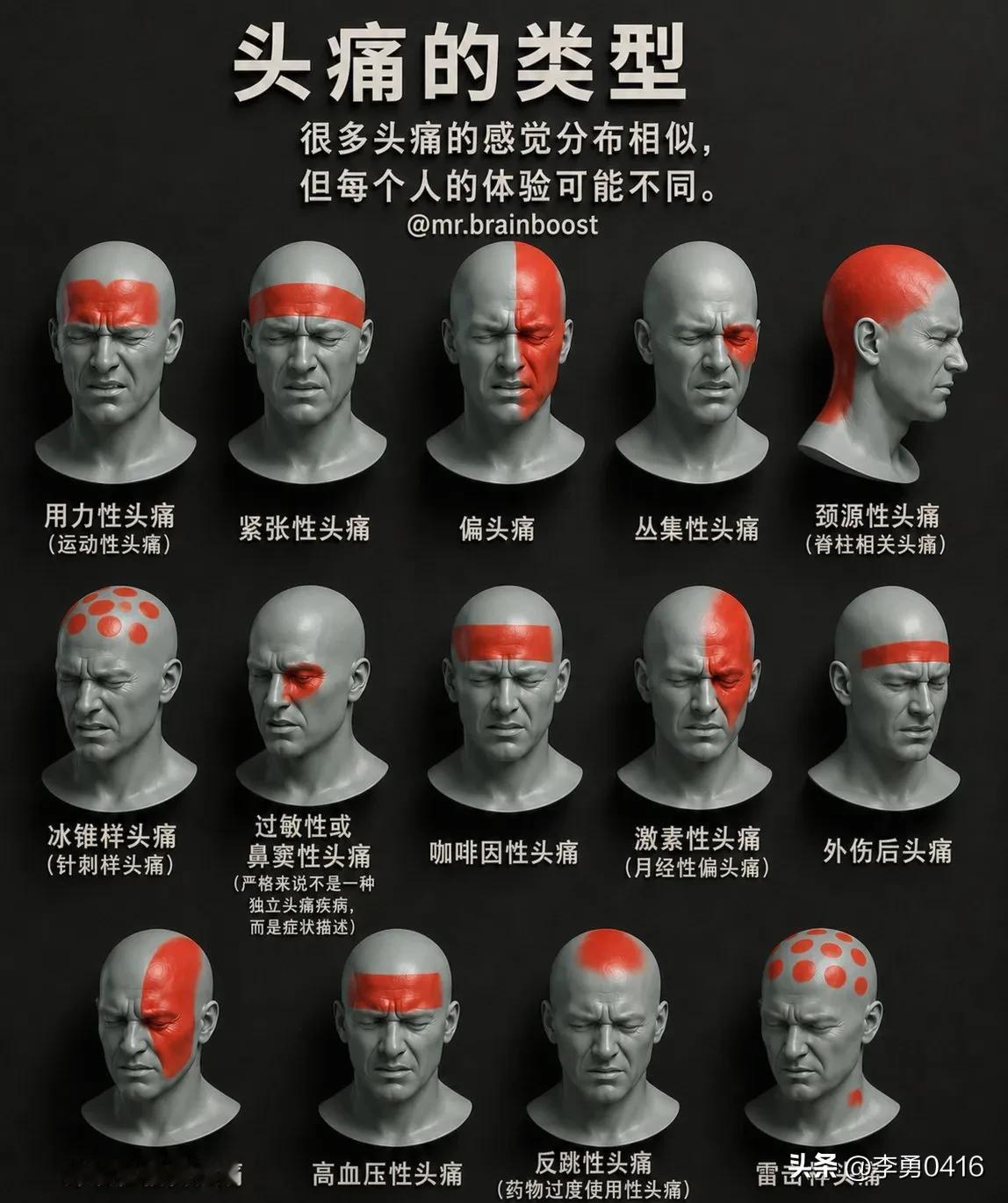 「医学科普：头痛的类型」很多头痛的感觉分布相似，但每个人的体验可能不同。