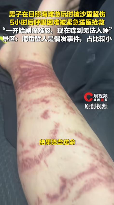 “瞧这事儿闹的！”近日，山东日照，一外地游客到海边景区游玩，结果不小心被海蜇给蜇