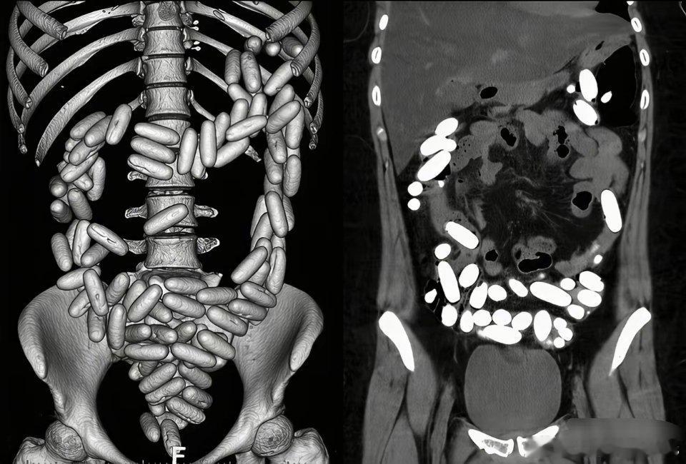胶囊状分布在大肠范围内，大家都猜猜看,这里面都是什么？
