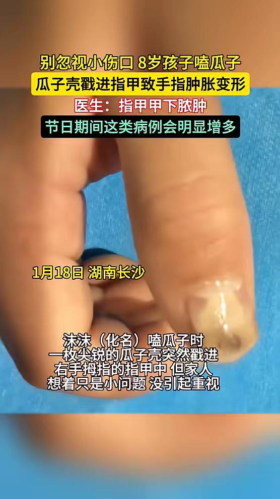 “悲剧还是发生了！”近日，湖南，一女孩和家人嗑瓜子，一枚尖锐的瓜子壳突然戳进女孩