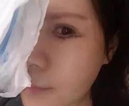 外切去眼袋第三天眼下变的黄黄的