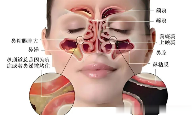 鼻炎鼻涕倒流, 就是一个个“垃圾堆”! 8味药治好10多年鼻炎。