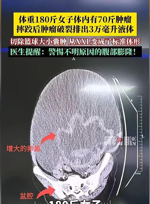 5月12日报道，浙江女子减肥多年，180斤体重纹丝不动，没想到摔了一跤后，肚子突