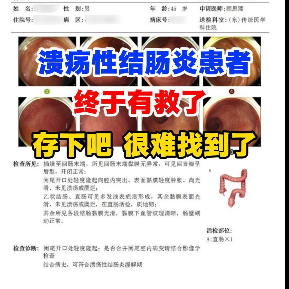 溃疡性结肠炎的朋友请存好，我只发这一回。 上个月门诊，一位45岁的男士...