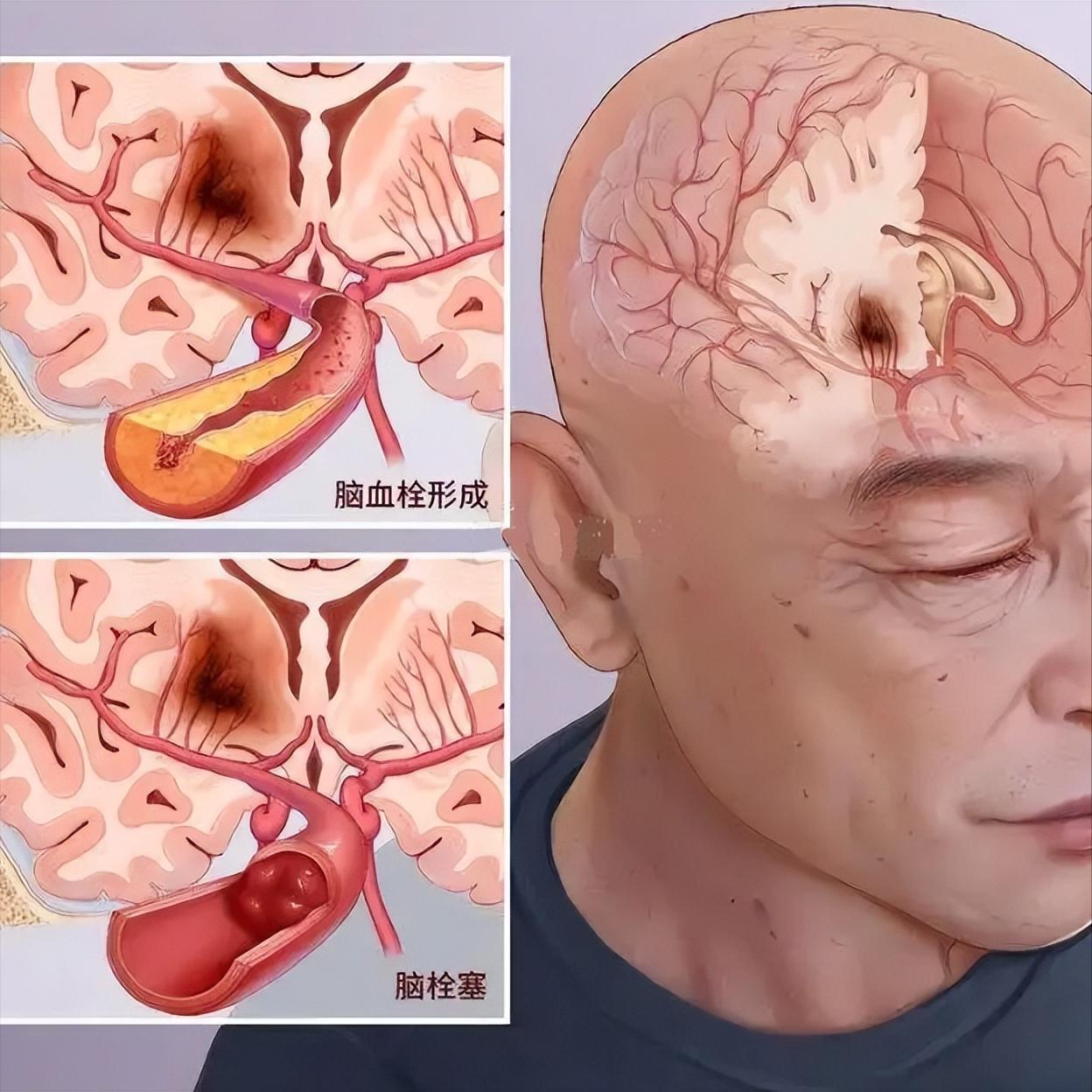 脑梗是怎么来的？这三个祸根，很多人天天都在做脑梗不是突然掉下来的，而是日积月