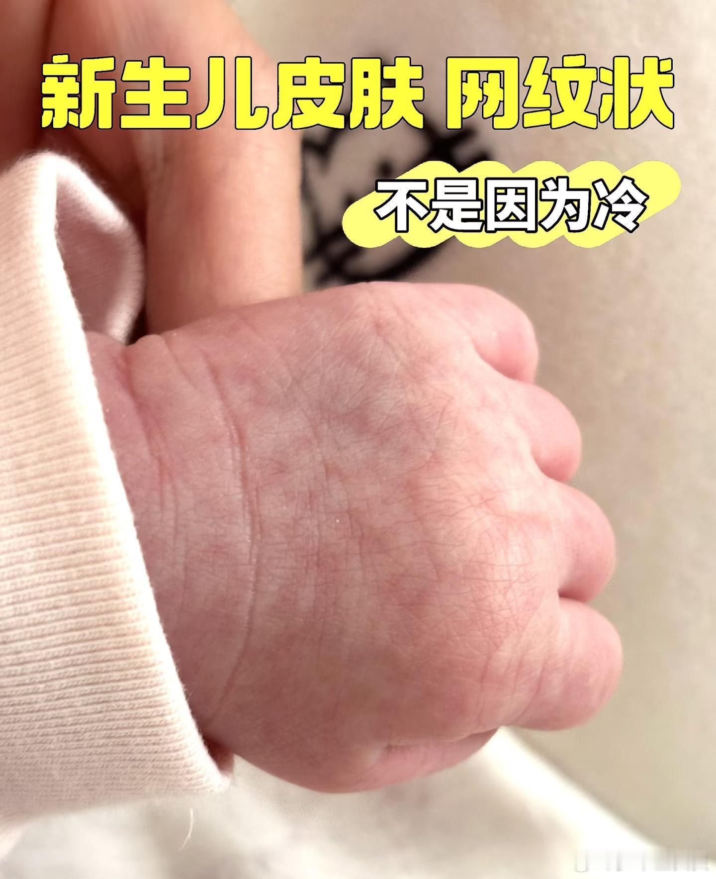 新生儿皮肤网纹状是什么原因宝宝出生后皮肤纹路明显，手背、大腿有明显的网纹，有