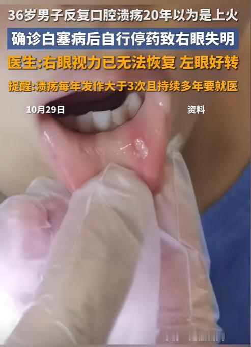 “悲剧还是发生了！”近日报道，陕西，一男子口腔溃疡反复20年，他以为是上火导致的