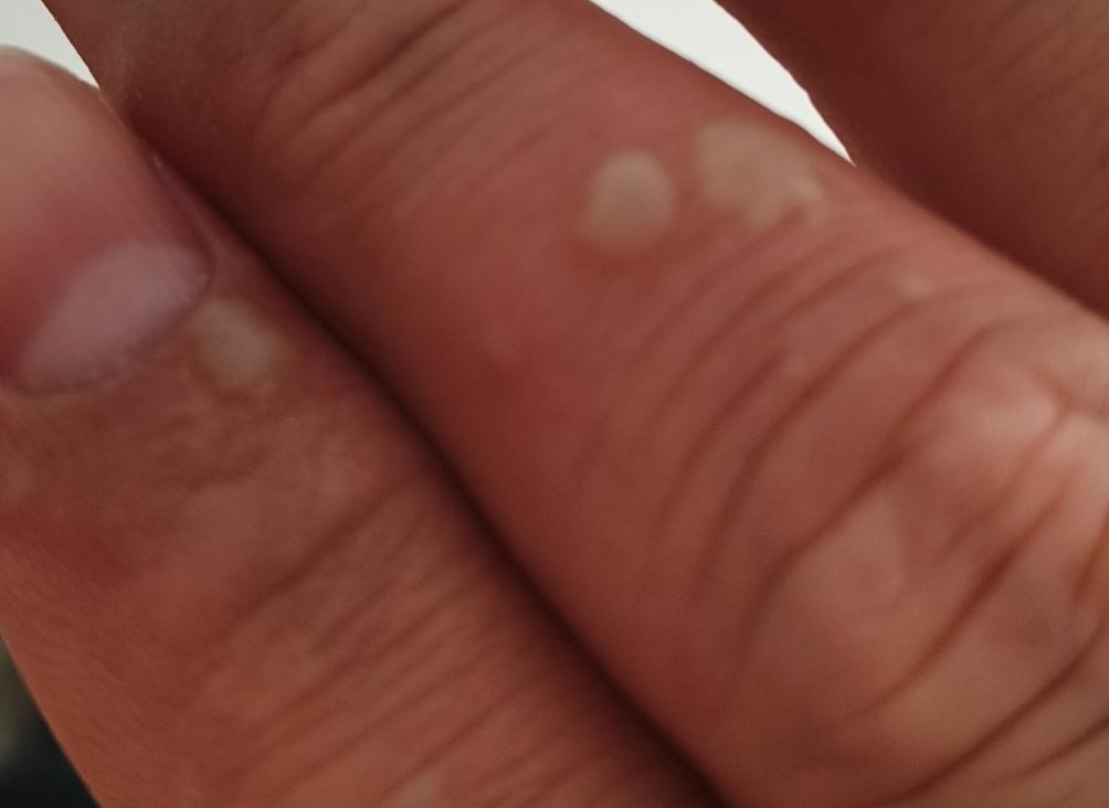 今天做饭手被烫伤，炒糖色时没控干水分的肉直接倒进锅里，然后。。。从未如此严重烫伤