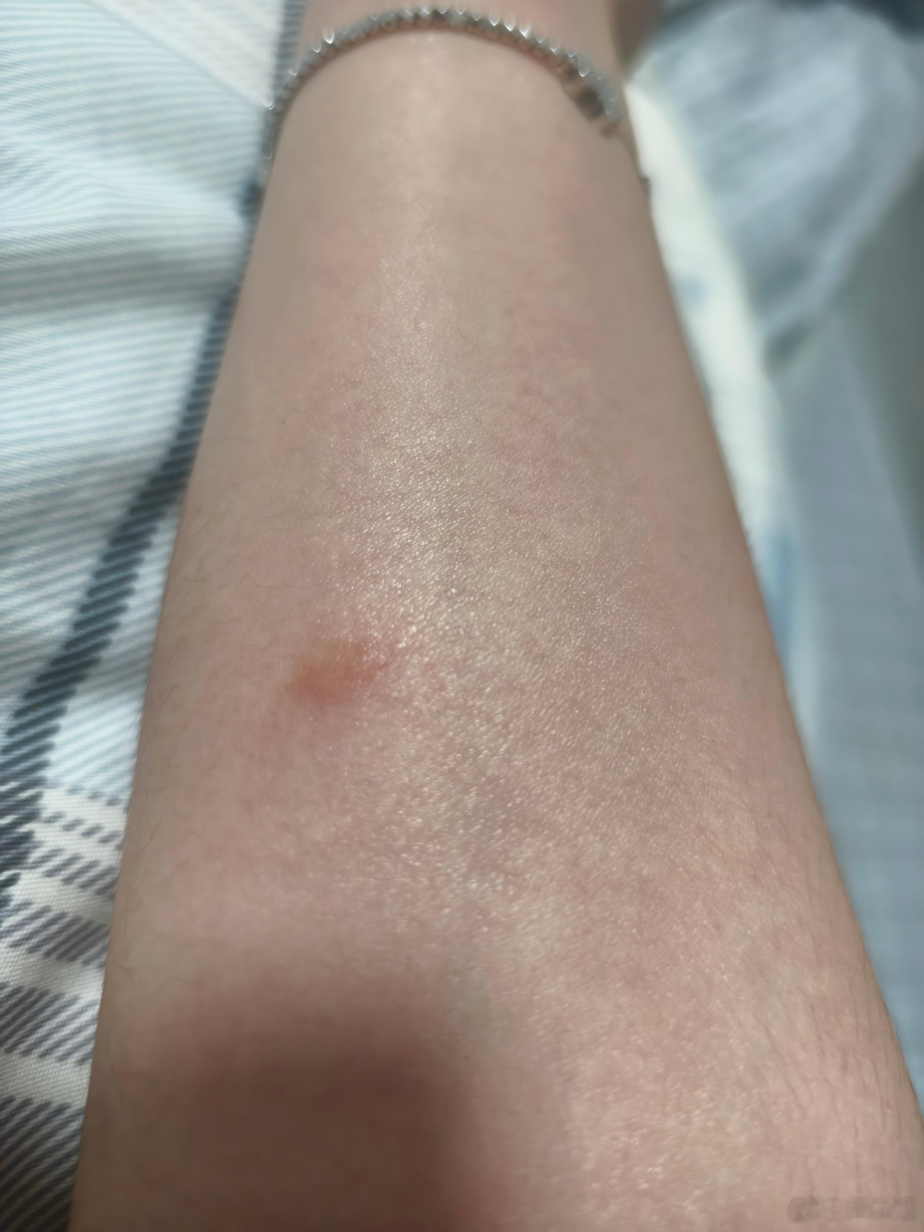 有相信玄学的吗？今天刚跟同事说完我只要身体抵抗力变差，这个地方就会起荨麻疹。上午