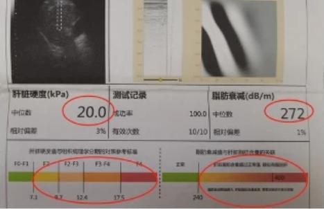 肝弹多少算肝硬化！1、肝弹 <7.3  正常范围2、肝弹7.3-9.7