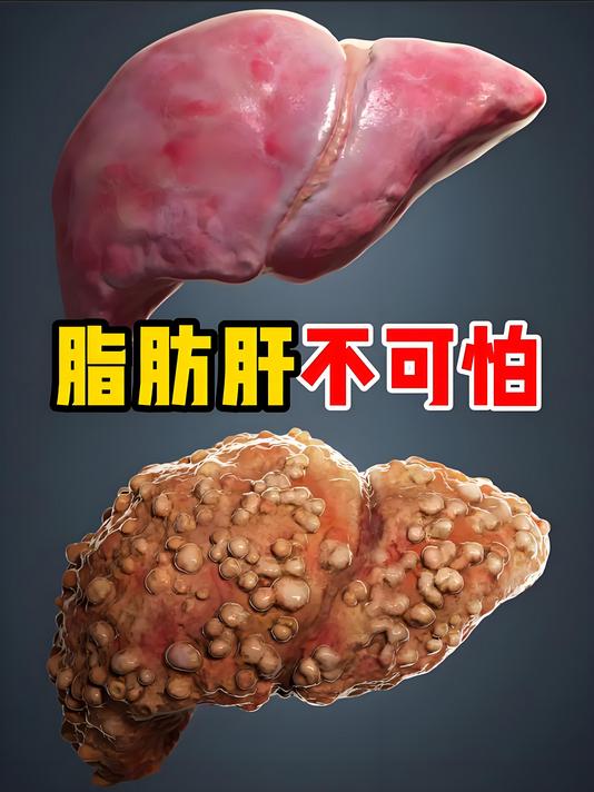 脂肪肝的
