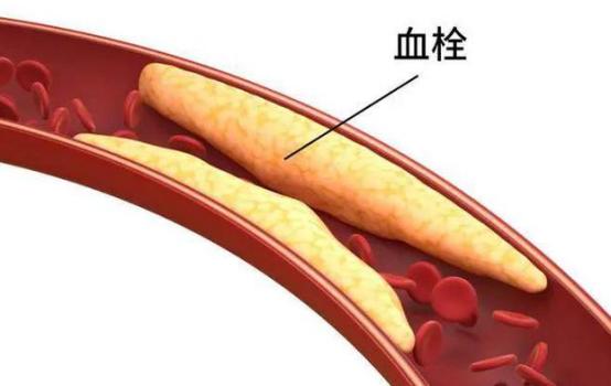 血管堵没堵，看脚就知道？提醒：若出现7种表现，或暗示血栓来临  血栓，血管
