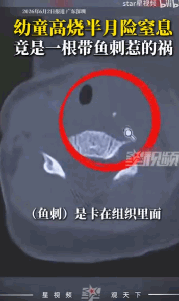 "太危险了！"深圳一个宝宝莫名高烧半个月，脖子肿得不敢动，夜里睡着睡着就开始打