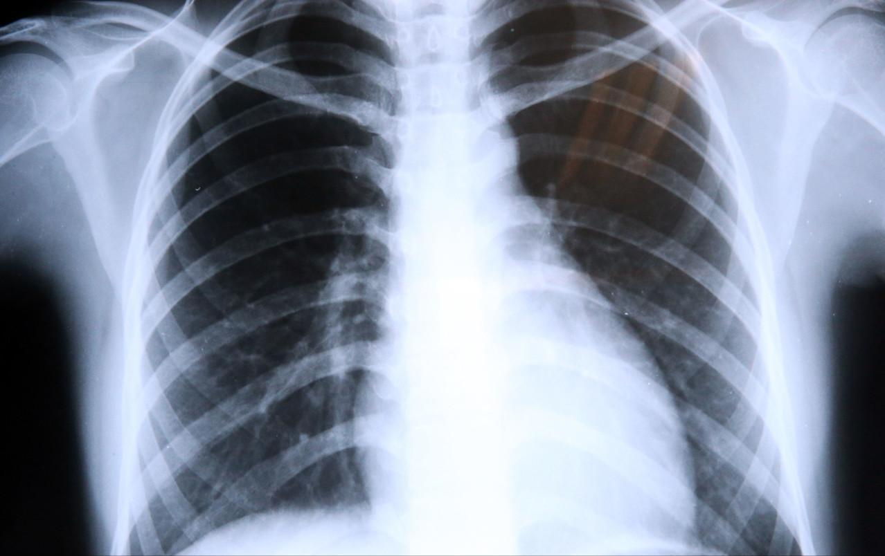 肺气肿和肺纤维化哪个更厉害，你知道两个病造成的后果就知道了肺气肿是肺里气太多造