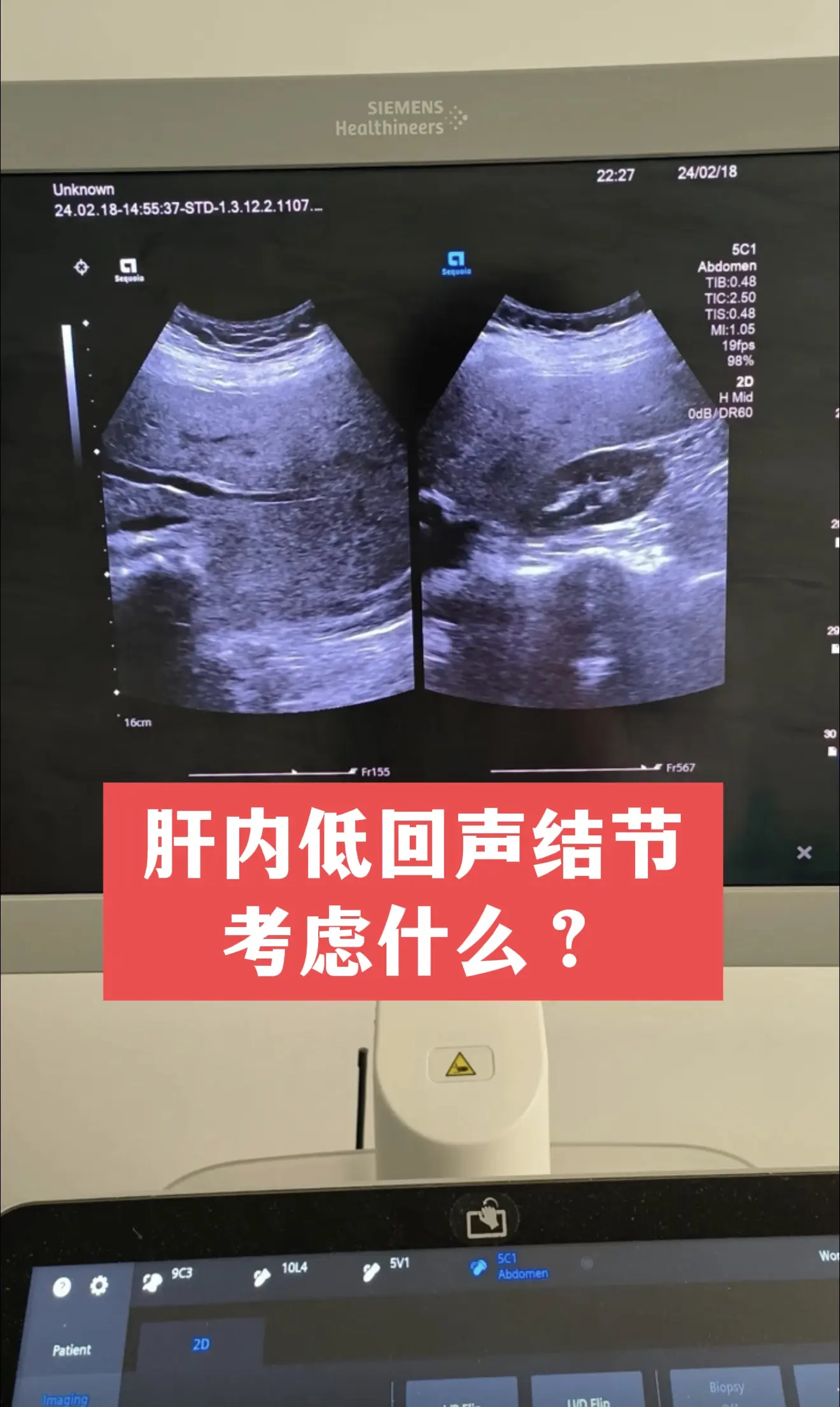 前几天门诊来了一位乙肝患者，做彩超报了肝内低回声结节，拿到报告整夜睡不...