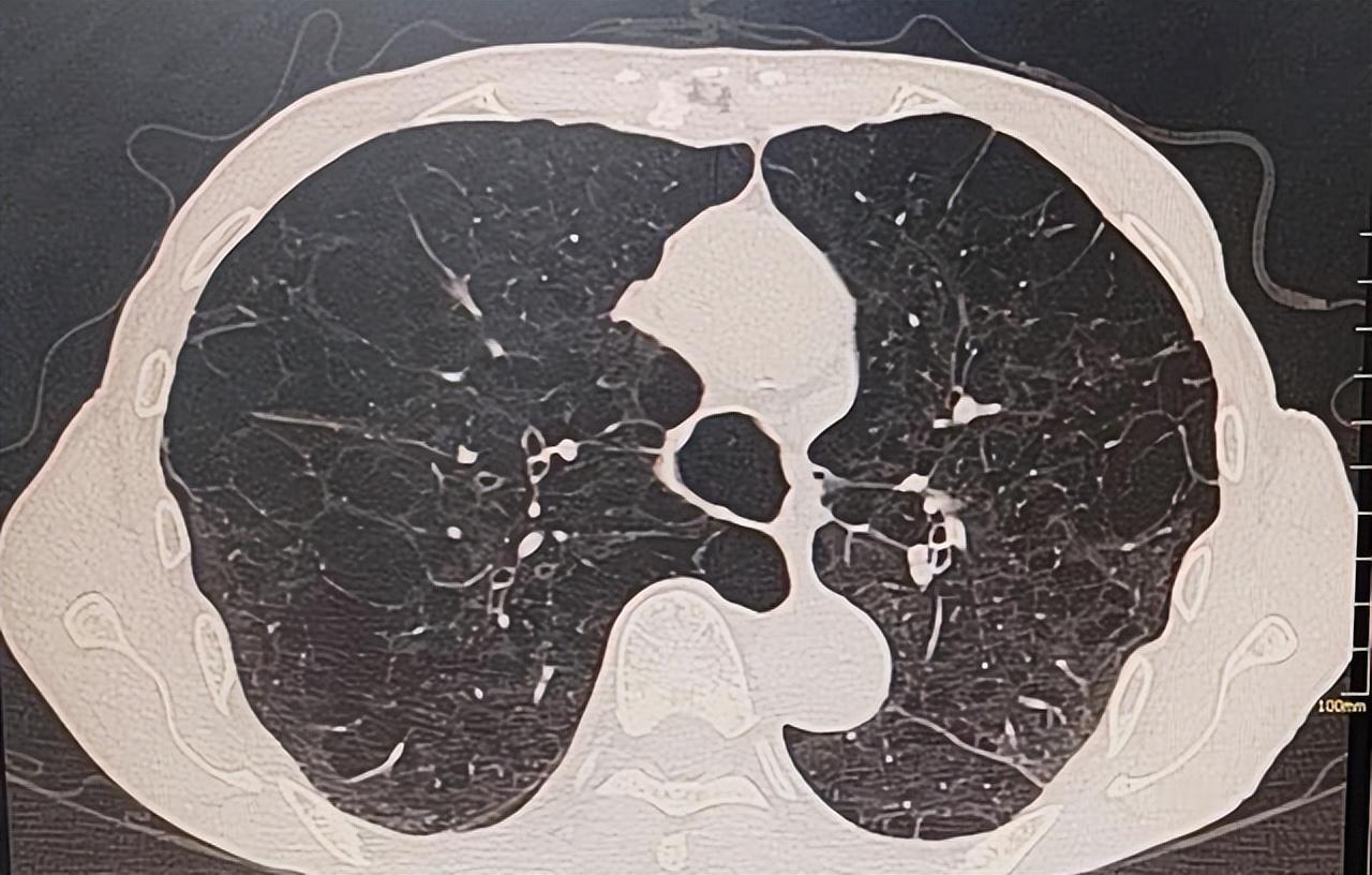 肺的“修复剂”找到了：5类食物每天换着吃，肺功能一天比一天好肺部健康一直是我
