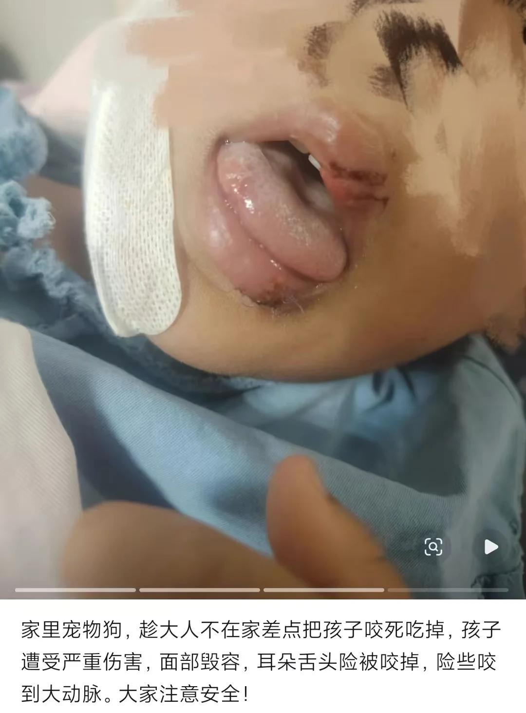 兔子急了还咬人，何况狗乎？江苏徐州。5岁男孩跟哈士奇玩，他把零食给狗，可能蹲