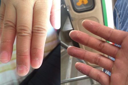 手脱皮吃什么维生素 解决方法你了解吗