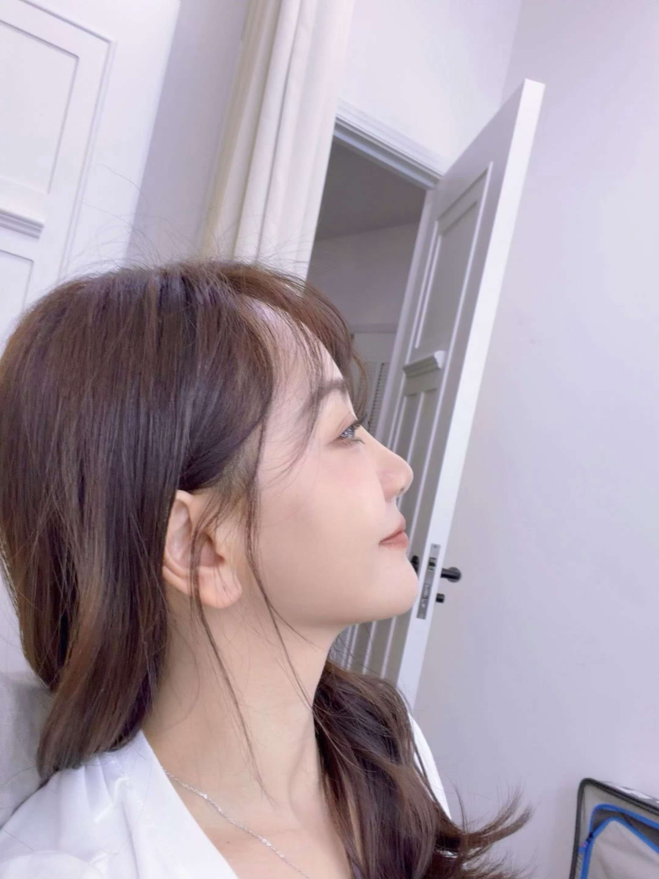 杨蓉面部烫伤恢复近照感觉恢复很多了呀