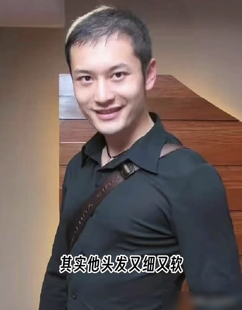 张卫健不是剃光头扮酷，是毛囊真死透了。当年拍《西游记》黏头套，胶水一天撕八回，头皮硬生生拽烂。毛囊坏