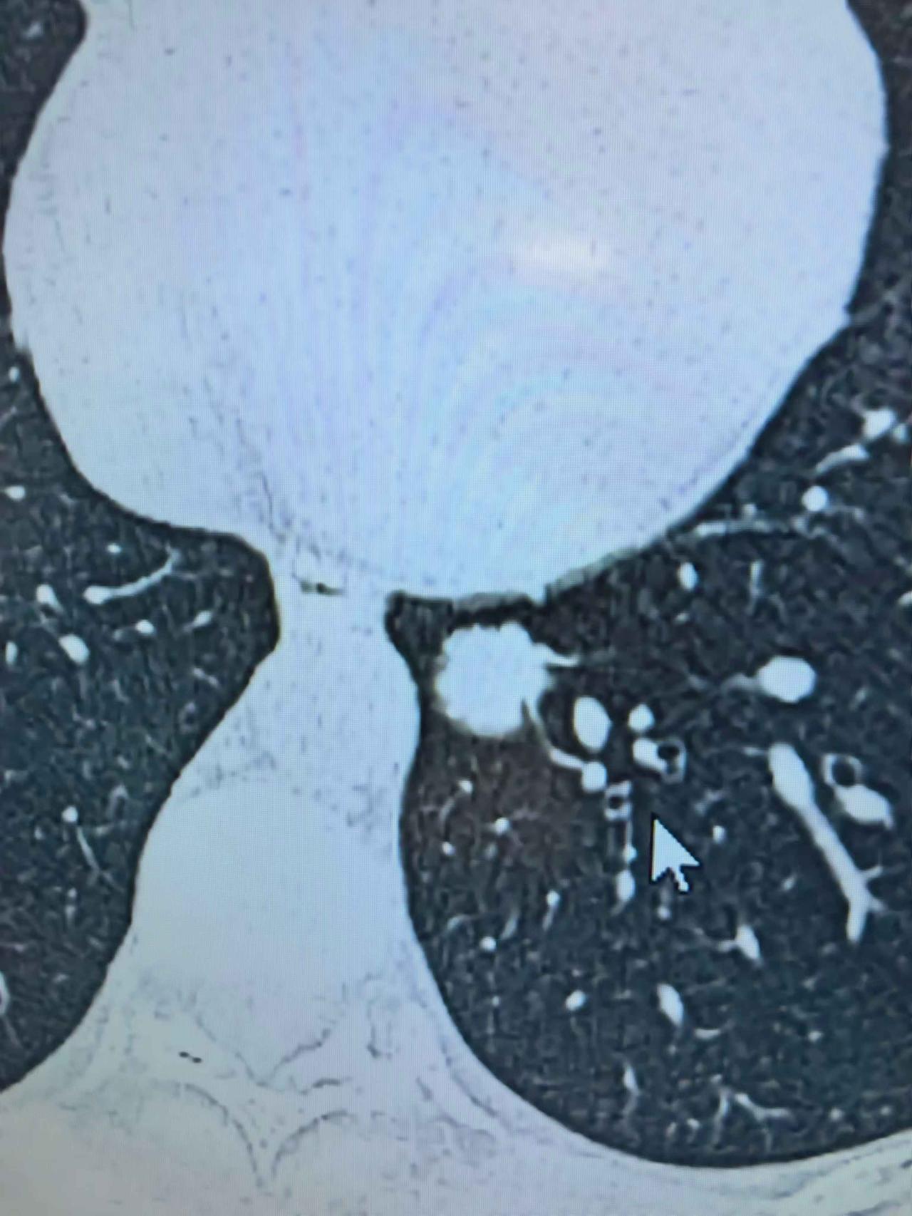 全部恶性特征都具备了，手术切出来竟然不是肺癌，连医生都没料到上次门诊上遇到一个