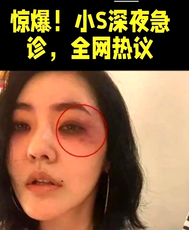 突发！小S深夜挂急诊！手臂惊现大片淤青画面曝光！