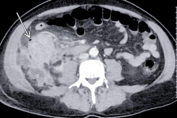 男子查出肠癌，崩溃大哭：肠癌早期不是便血，而是身上5个异常肠道问题一旦被提起