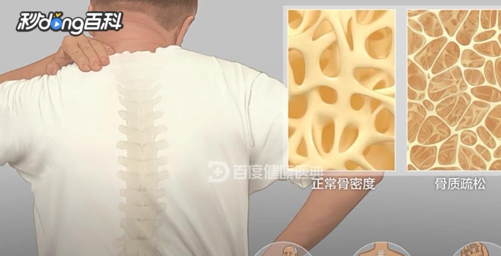 骨质疏松：悄无声息的骨骼危机骨质疏松是一种全身代谢性骨病，特征为骨量显著减少