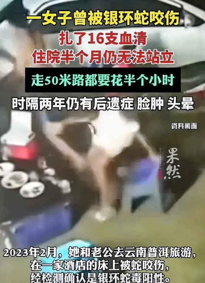 银环蛇真的太毒了！一女子2年前去云南普洱旅游，夜晚躺酒店床上被银环蛇咬伤。尽管打